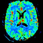 Perfusion