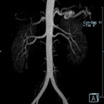 Aorta