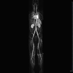 Ganzkörper Angiographie mit Kontrastmittel